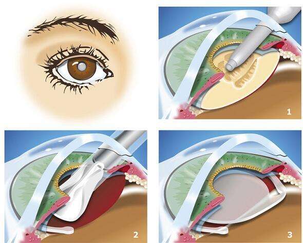 冷超声乳化治疗白内障详解